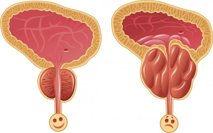 Prostate saine et prostatite