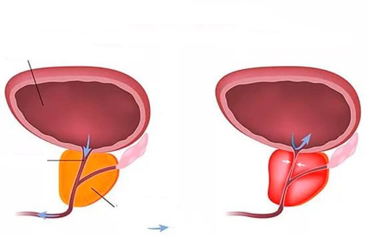 prostate normale et enflée