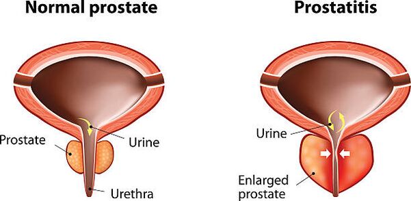 prostate normale et enflée